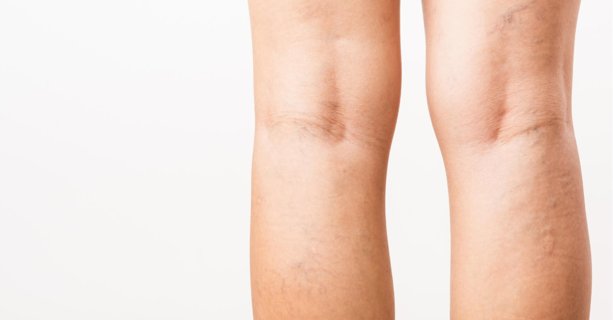 How to Prevent Varicose Veins from Worsening