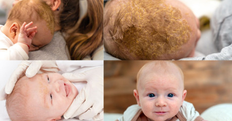 Zakaj se pri dojenčku pojavi seboroični dermatitis?