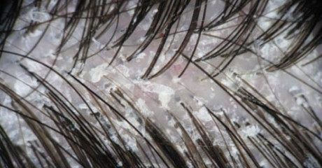 Kdaj se pojavi seboroični dermatitis lasišča