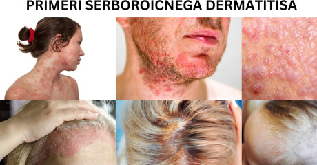 Seboroični dermatitis: vse, kar morate vedeti in 7 pogostih napak pri zdravljenju
