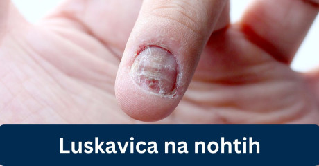 Luskavica na nohtih - Kako jo prepoznati in obvladovati