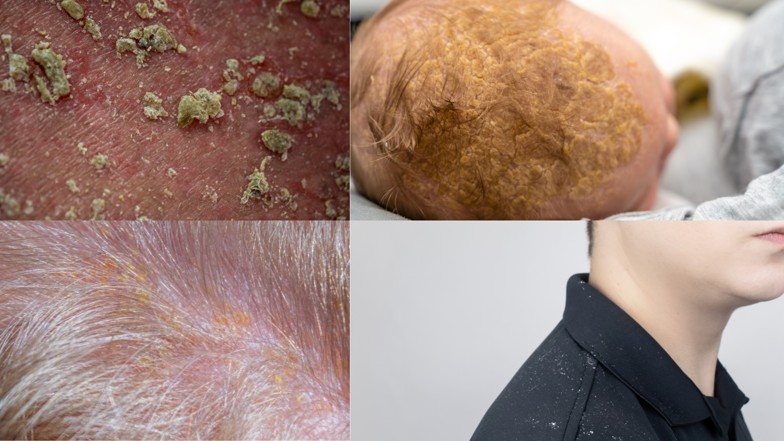 seboroicni dermatitis