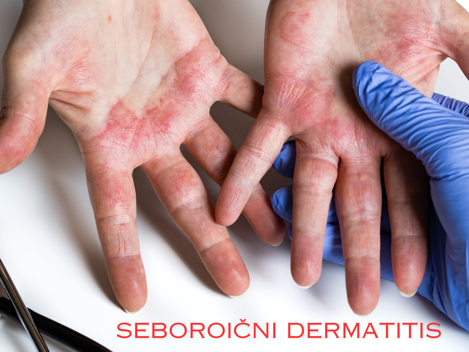 seboroicni dermatitits