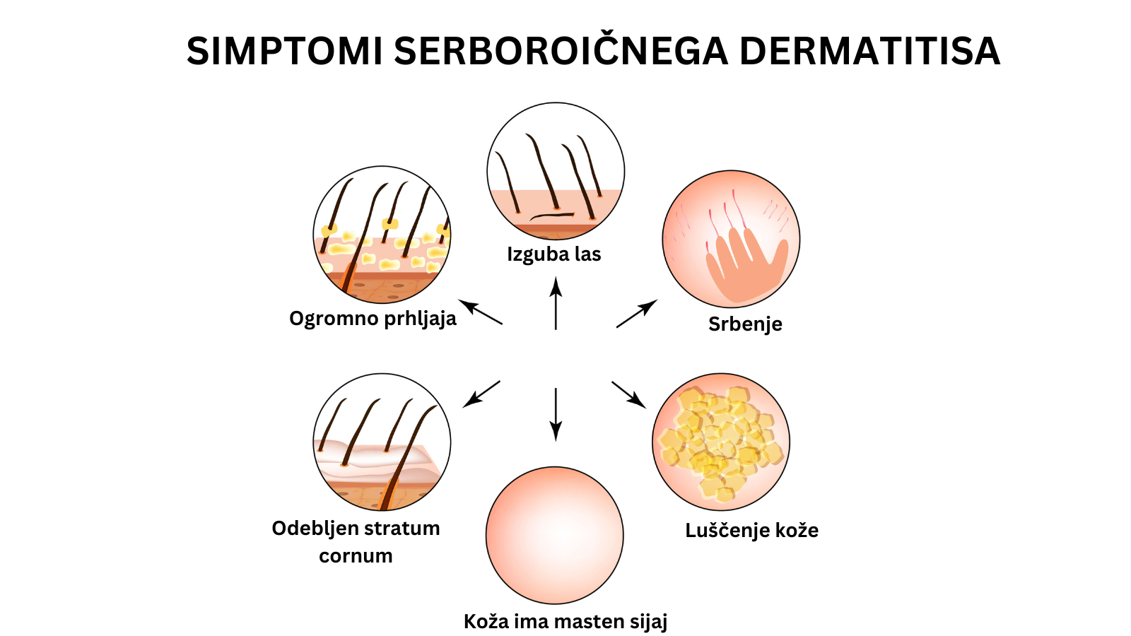 seboroicni dermatitis