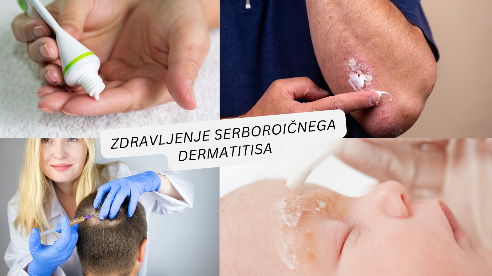 seboroicni dermatitis